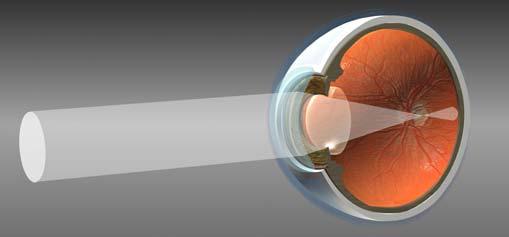 Miopia: i raggi cadono davanti alla retina